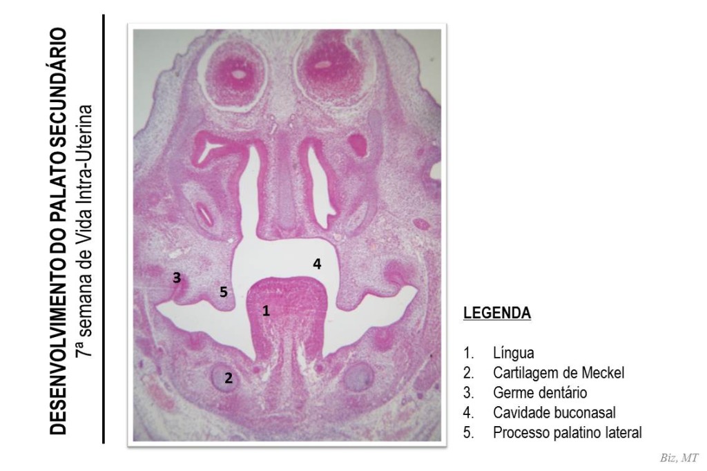 7a SEMANA DE VIDA INTRA-UTERINA: Esta imagem apresenta um corte frontal da cabeça de feto de rato. É possível identificar claramente a língua ocupando a região da futura cavidade bucal. Abaixo da língua há uma estrutura esférica composta de cartilagem hialina, a cartilagem de Meckel. Pode-se notar, ainda, o início do desenvolvimento dos germes dentários (projeção pequena do epitélio para o interior do ectomesênquima). Note que ao lado da língua há os processos palatinos laterais que encontram-se verticalizados, ou seja, ainda não há divisão entre a cavidade bucal e nasal. Esta característica de posicionamento dos processos palatinos laterais correspondem a de um embrião humano na 7ª semana de vida intra-uterina.