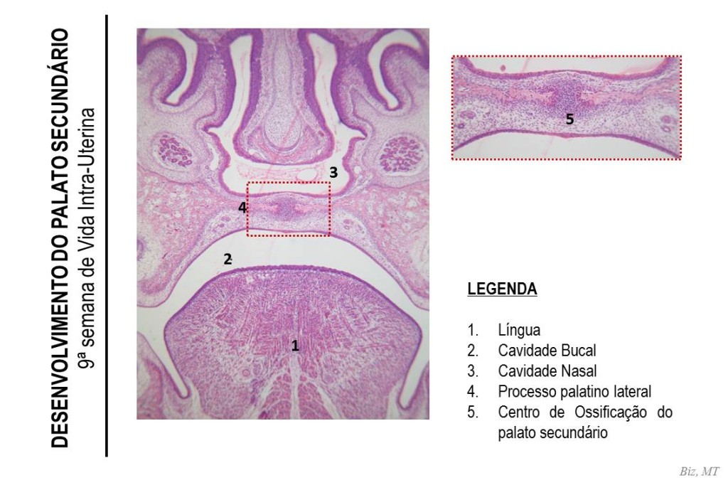 9a SEMANA DE VIDA INTRA-UTERINA: Assim como na imagem anterior, é possível identificar a língua em primeiro plano e observar que os processos palatinos laterais encontram-se horizontalizados e completamente fusionados, ou seja, a separação entre cavidade bucal e nasal completou-se. Observe o centro de ossificação no local de fusão dos processos palatinos lateriais (maior aumento), característica de uma fase mais adiantada da 9ª semana de vida intra-uterina.